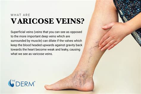 Overcome the Pain and Discomfort of Varicose Veins: Tips for Managing Symptoms
